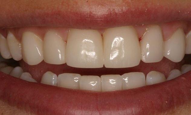 Porcelain-Veneers-After-Image