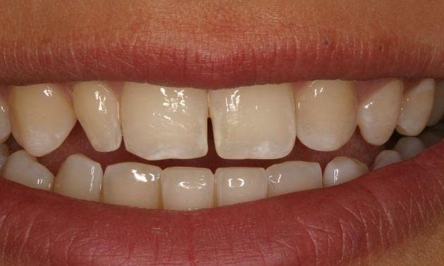 Porcelain-Veneers-Before-Image